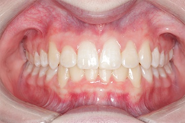 Close up of mouth with aligned teeth after orthodontic treatment in Amityville