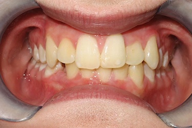 Close up of mouth with misaligned teeth