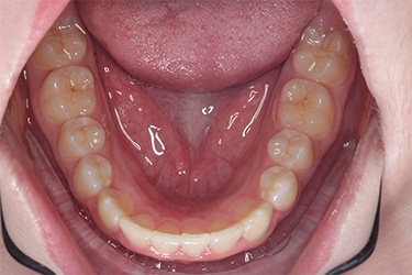 Lower arch of well aligned teeth