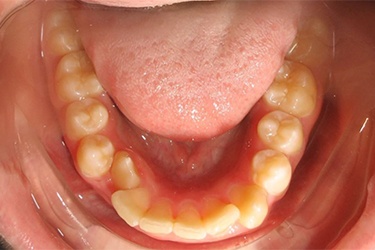 Lower arch of misaligned teeth