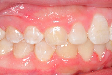 Row of well aligned and evenly spaced upper teeth