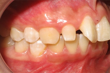 Row of misaligned and gapped upper teeth