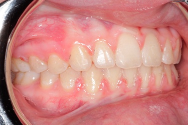 Mouth after correcting slight overbite