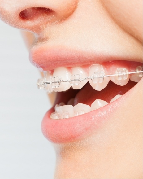 Close up of person smiling with clear braces on their teeth