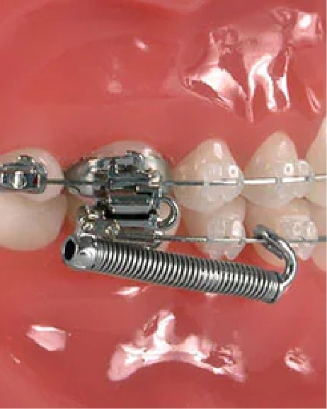 Set of springs attached to brackets on braces