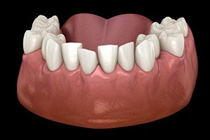 Digital image of crowded teeth