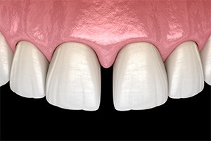 Digital image of gapped teeth