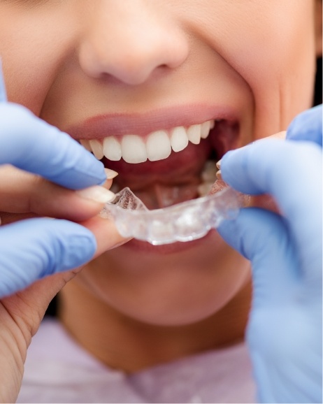 Close up of orthodontist fitting a patient with an Invisalign aligner