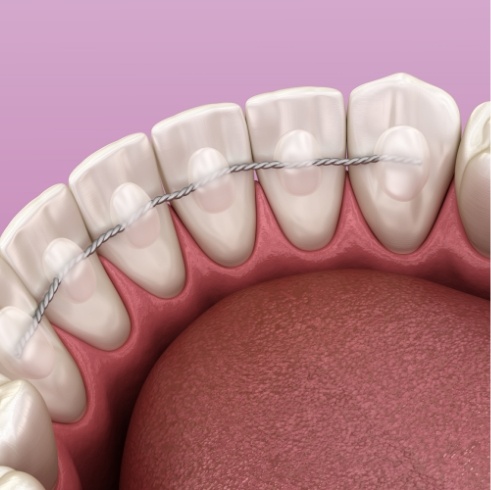 Illustrated retainer fixed onto back surfaces of lower arch of teeth