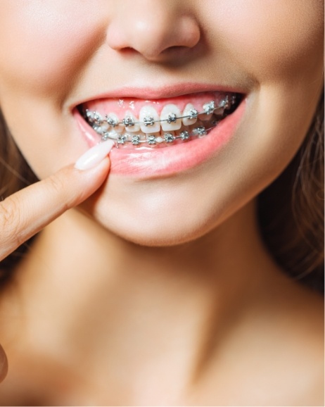 Close up of person pointing to their braces